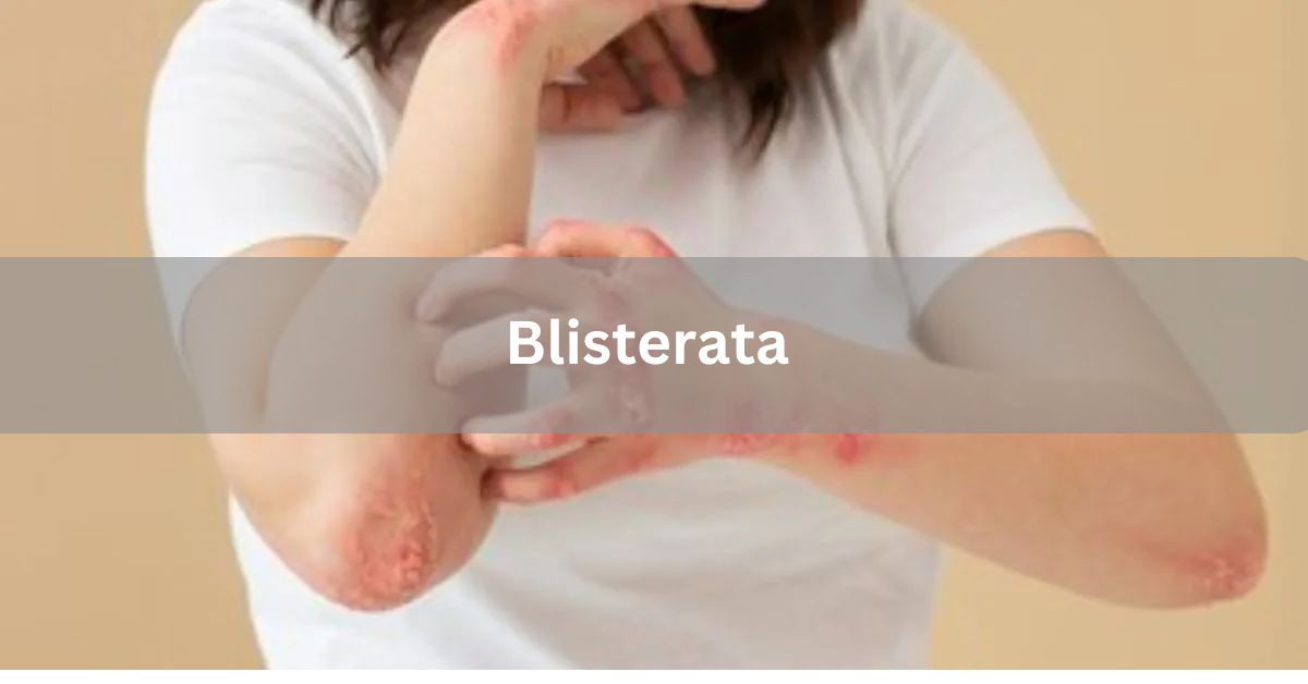 Blisterata - The Complete Handbook for Skin Without Blisters!