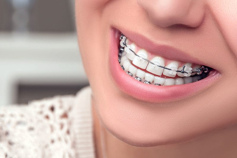 Straight Smiles, Healthy Lives: How Orthodontics Transforms Oral Health